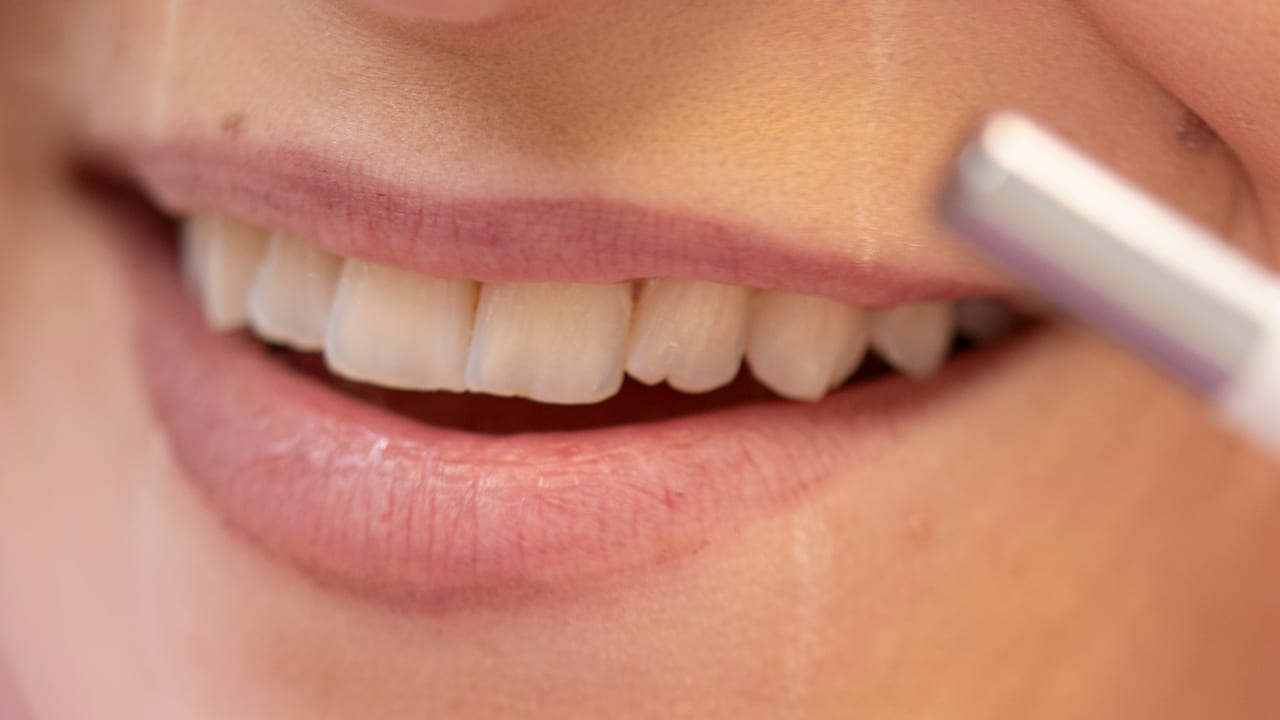 Sbiancamento dei denti a Nova Gorica per un sorriso naturale più luminoso