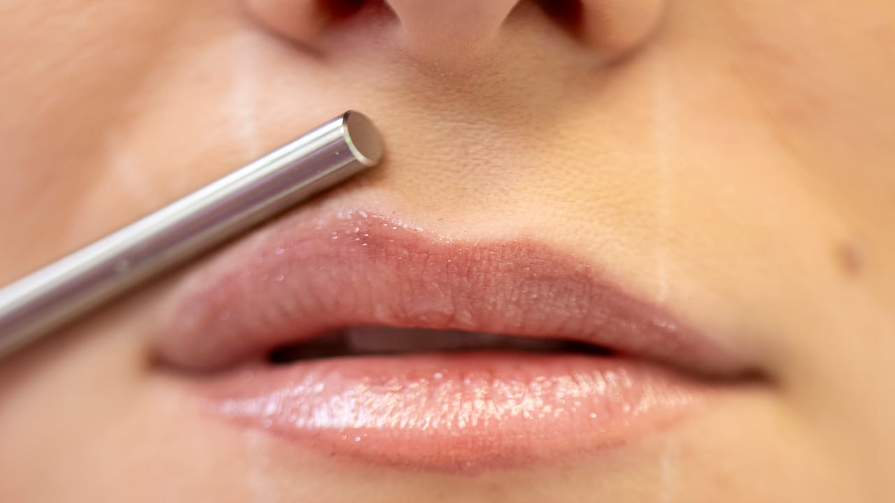 Lips during dermal filler planning with hyaluronic acid in Nova Gorica